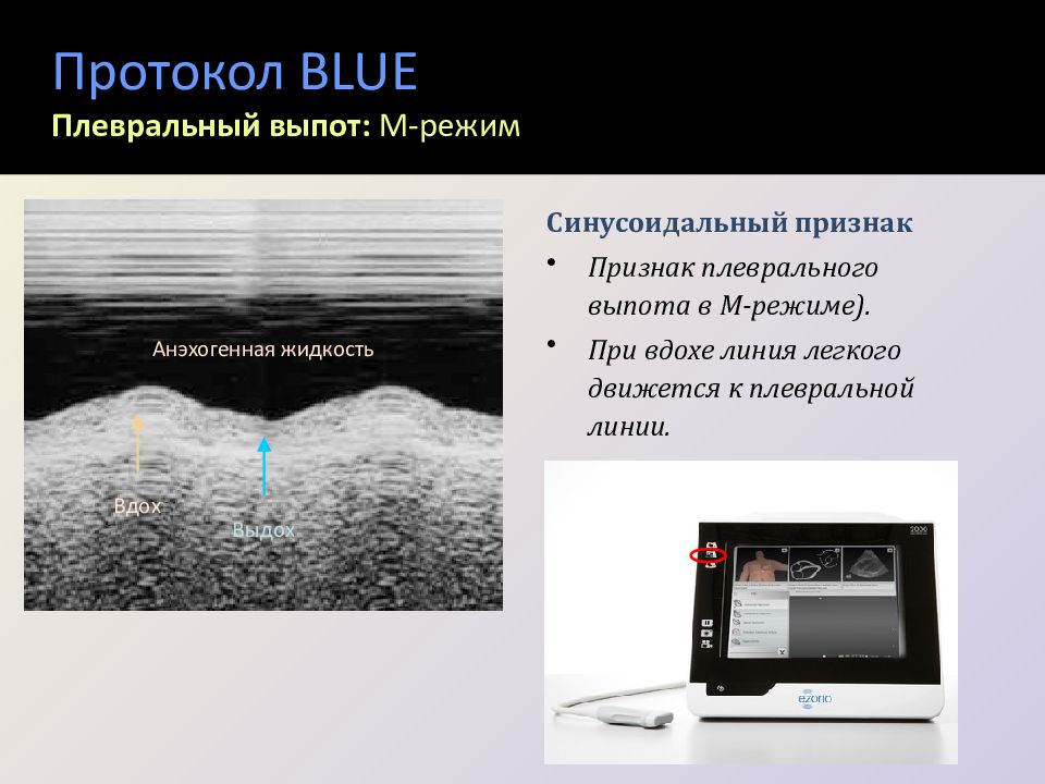 Узи плевральной. УЗИ легких протокол исследования. Blue протокол УЗИ. УЗИ плевральных синусов протокол. Плевральные выпот УЗИ протокол.