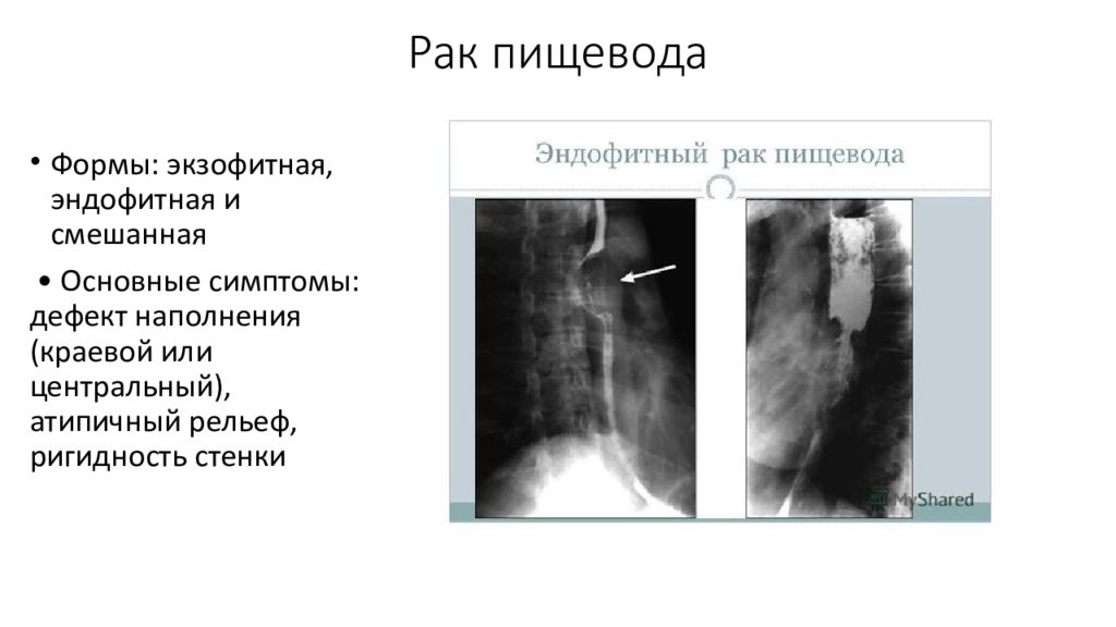 Рентгенологическая картина рака пищевода экзофитный эндофитный