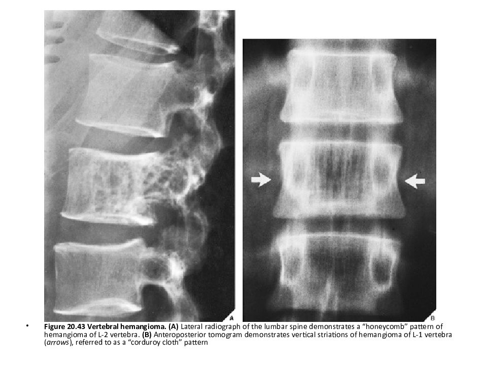Что такое гемангиома позвоночника. Гемангиома позвонка рентген. Гемангиома позвонка на рентгенограмме. Гемангиома тела позвонка рентген. Гемангиома позвонка рентген признаки.