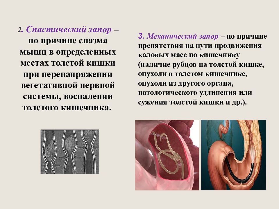 Почему запор у женщин причины. Спастический колит кишечника. Спастическое состояние кишечника. Для спастического колита характерны.