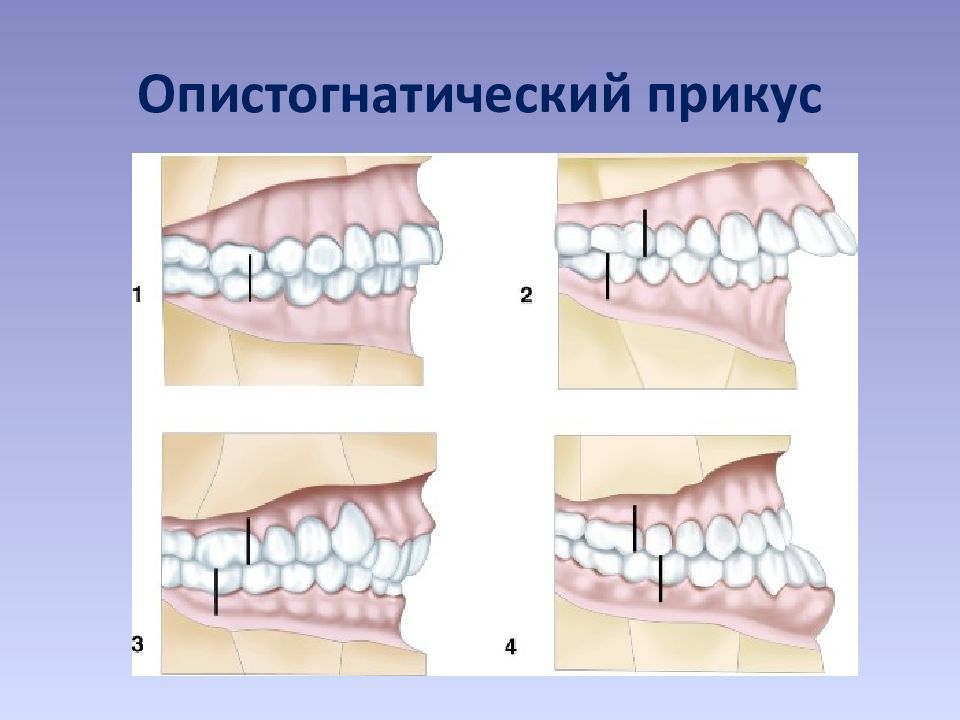 Нормальный прикус. Сагиттальныt аномалиb прикуса. Дистальный прикус ретрузия. Классификация аномалий окклюзии Энгля. Дистальный прикус по Энглю.