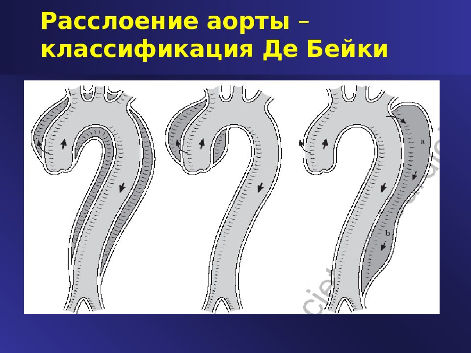 дебейки типы расслоения аорты. диссекция аорты тип 1 по де бейки. расслоение аорты классификация. классификация расслоения аорты по дебейки. расслаивающая аневризма аорты 1 типа по дебейки.