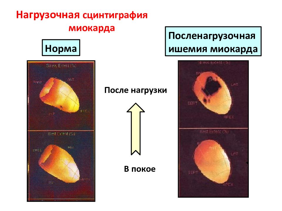 Презентация сцинтиграфия миокарда