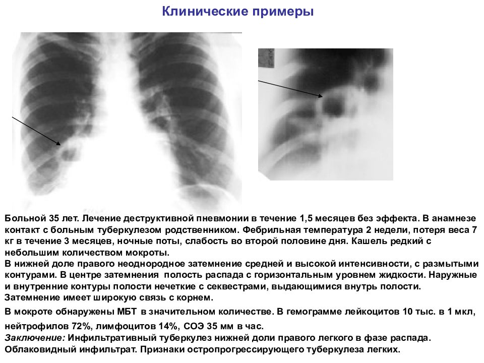 Рентген легких при туберкулезе фото с описанием