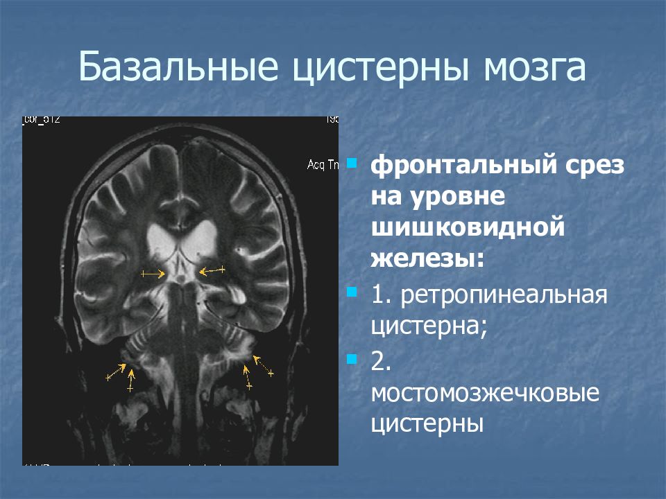 Цистерны мозга расширены