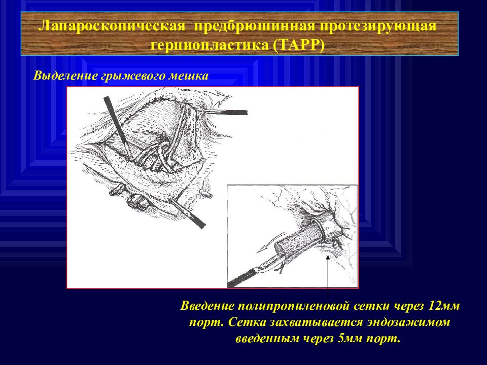 Герниопластика. Лапароскопическая предбрюшинная протезирующая герниопластика. Местный статус после Тарр герниопластики.