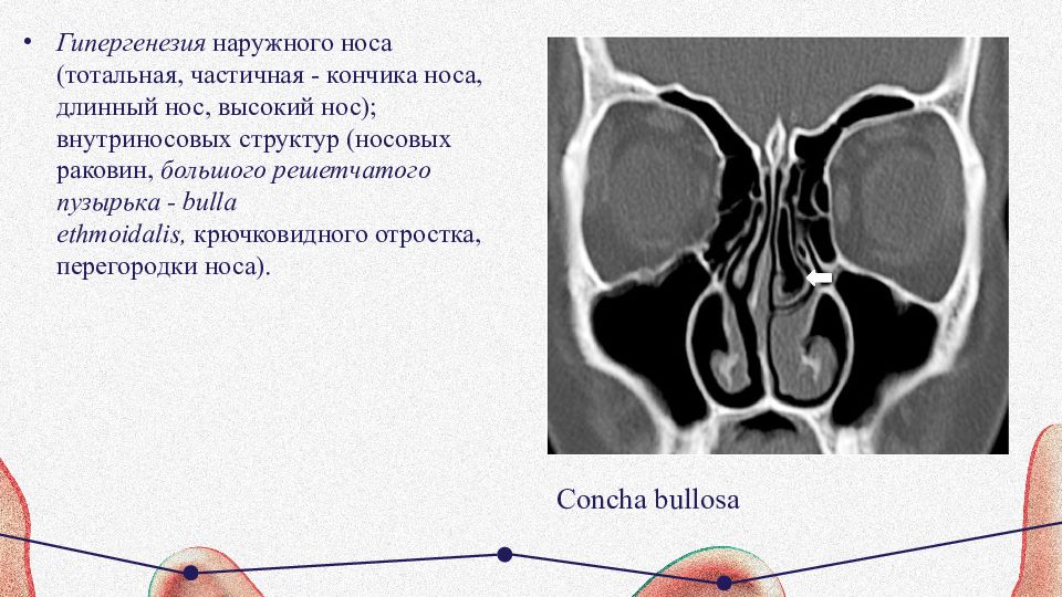 Concha bullosa средних носовых раковин что это