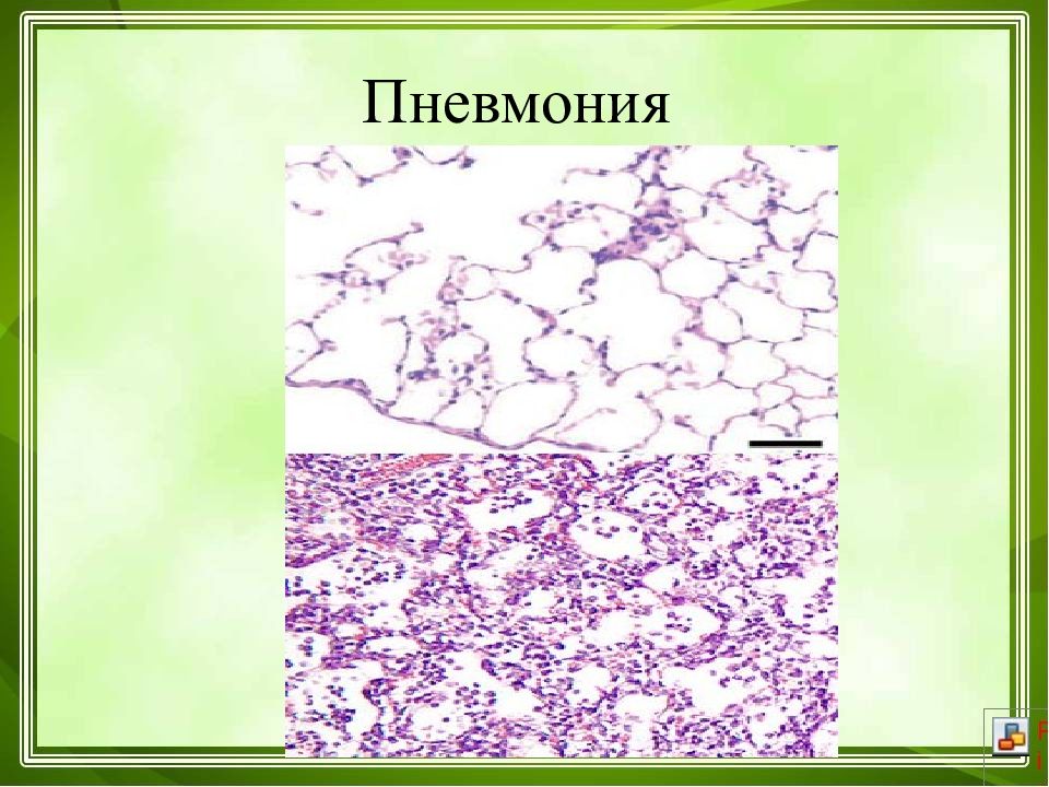 стафилококк pneumoniae