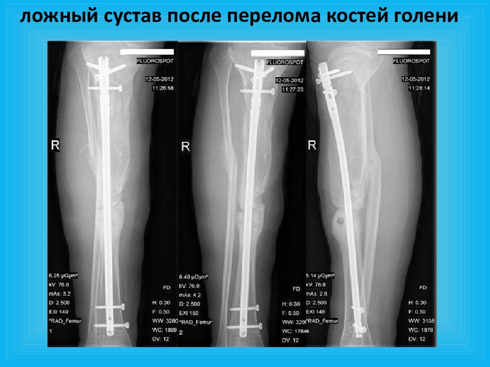 Как убрать мозоль после перелома. Ложный сустав большеберцовой кости. Ложный сустав бедренной кости. Ложный сустав малоберцовой кости. Ложный сустав после перелома большеберцовой кости.