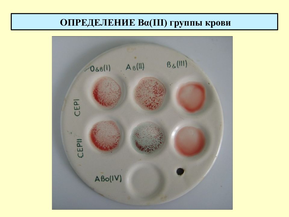 Группа крови определение цоликлонами фото