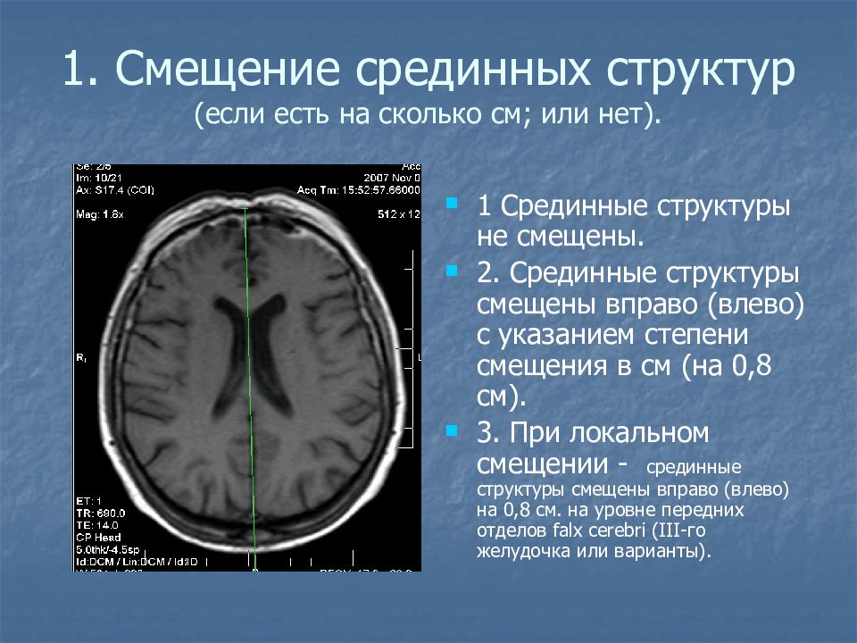 Дистрофические дисциркуляторные изменения мозга. Дислокация срединных структур головного мозга кт. Гидроцефалия головного мозга мрт. Смещение структур головного мозга. Смещение срединных структур головного мозга мрт.
