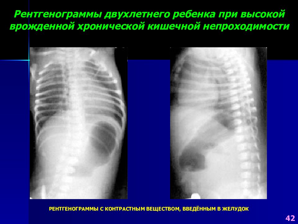 Врожденная кишечная непроходимость. Врожденная кишечная непроходимость рентген. Врожденная кишечная непроходимость рентгенограмма. Врожденная высокая кишечная непроходимость у детей. Высокая кишечная непроходимость у детей рентген.