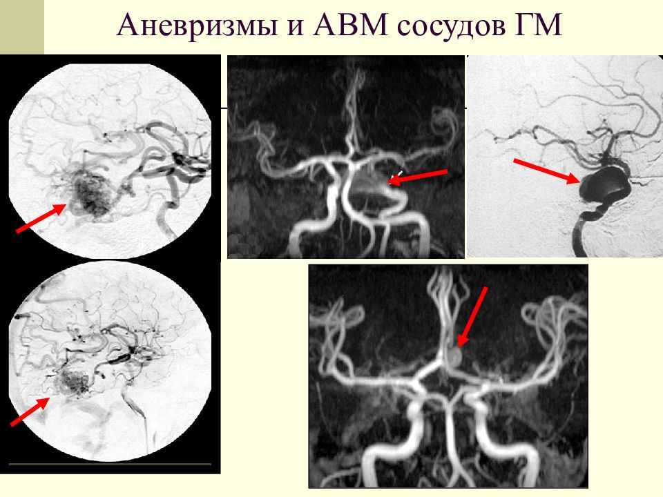 Презентация аневризмы сосудов головного мозга