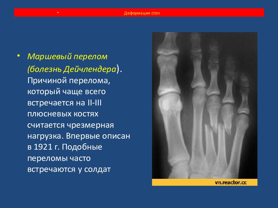 Презентация перелом стопы