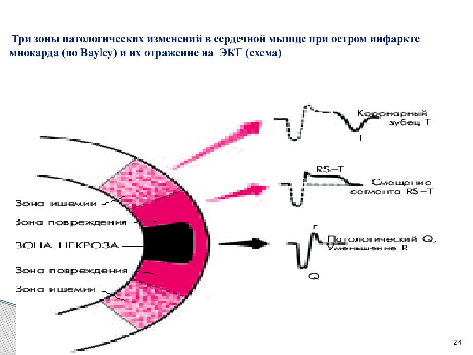 Признаки трансмурального инфаркта. Трансмуральный инфаркт миокарда. Динамика ОИМ трансмурального. Трансмуральное давление. Инфаркт миокарда трансмуральный передней стенки.