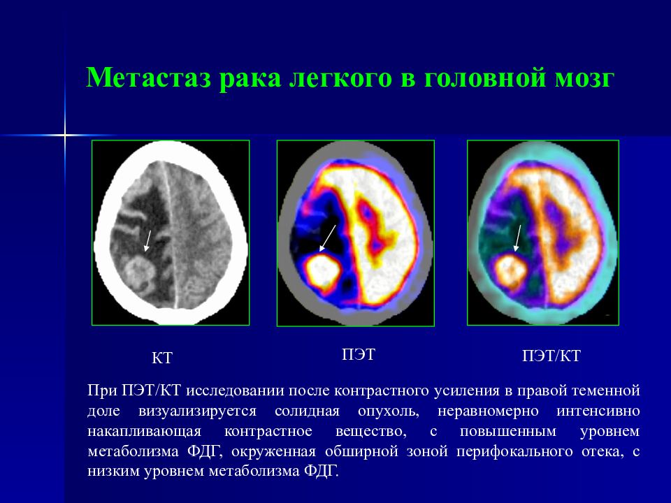 Метастазирование злокачественных. Метастазы головного мозга кт кт. ПЭТ кт опухоли головного мозга.
