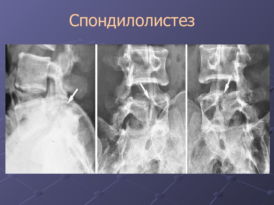 Спондилолистез. Спондилолистез лучевая диагностика. Спондилолистез классификация. Классификация спондилолистеза. Спондилолистез рентгенодиагностика.