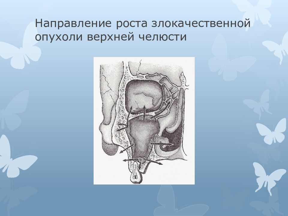 Резекция верхней челюсти презентация