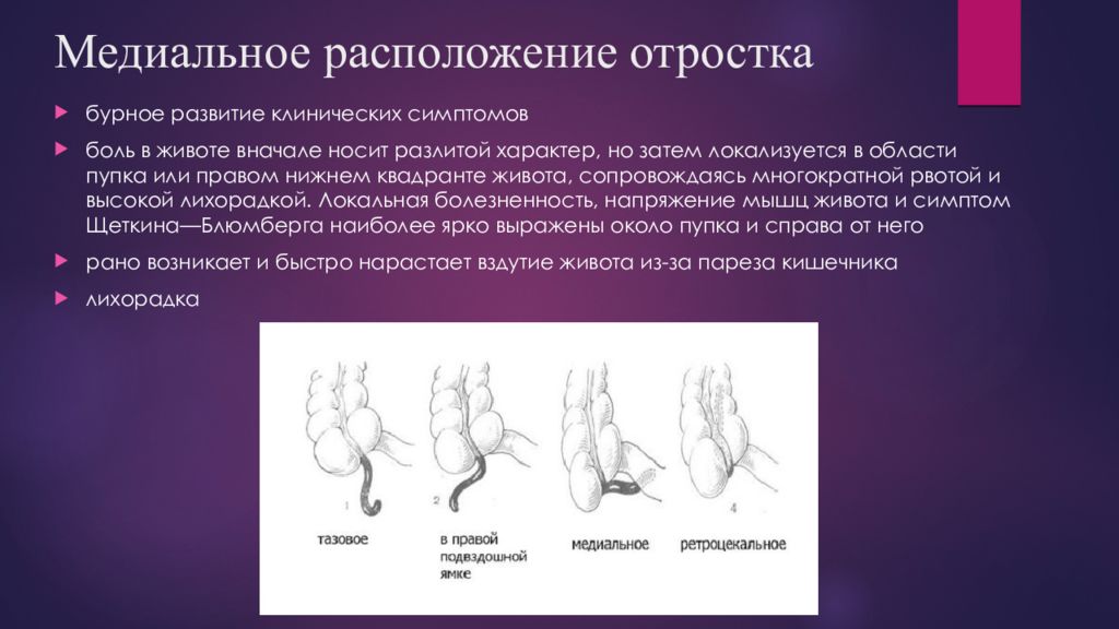 Осложнения аппендицита. Медиальное расположение червеобразного отростка. Аппендицит медиальное расположение. Медиальное расположение аппендикса. Медиальное расположение отростка.