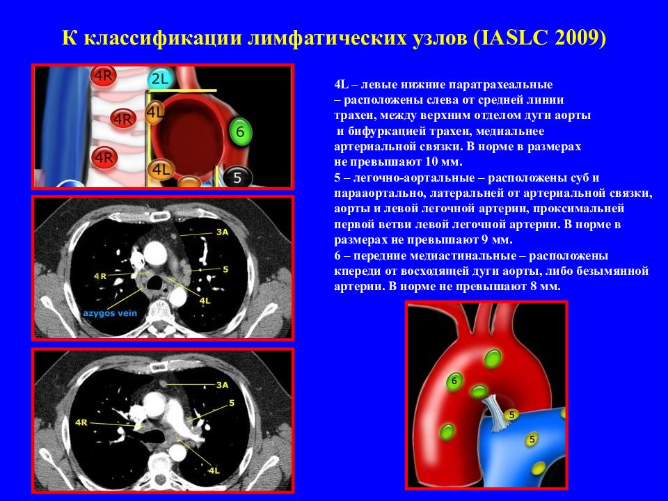 5 групп лимфоузлов. Лимфоузлы средостения кт. Лимфоузлы средостения кт анатомия. Паратрахеальные лимфатические узлы рентген. Группы лимфоузлов средостения на кт.