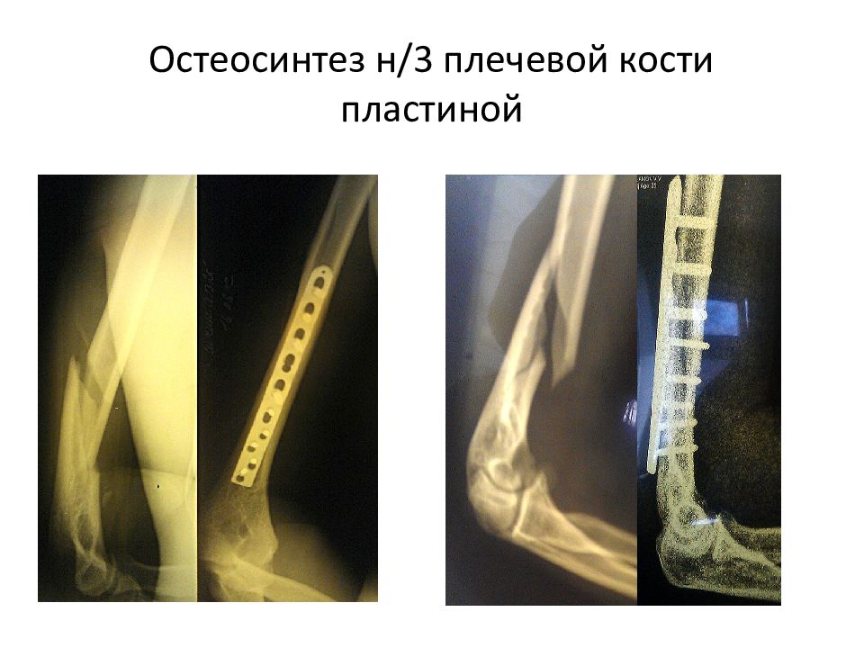 Переломы плечевой кости травматология презентация