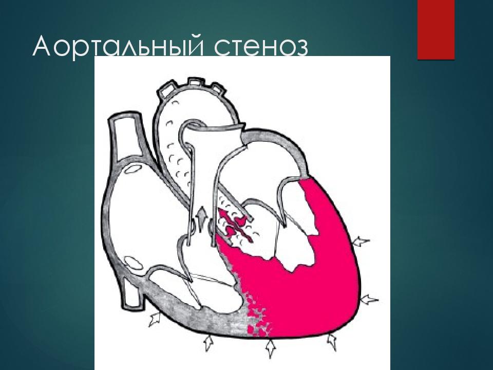 Как выглядит порок сердца на картинке