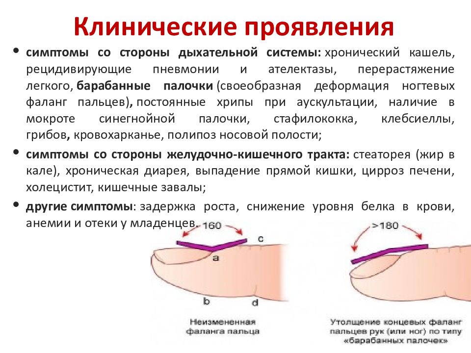 Клиническая картина муковисцидоза