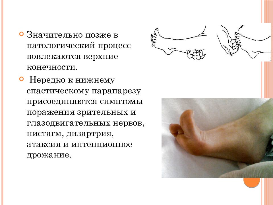 Штрюмпеля болезнь презентация