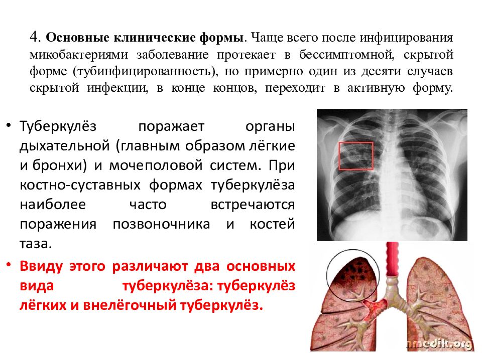 Закрытая форма туберкулеза