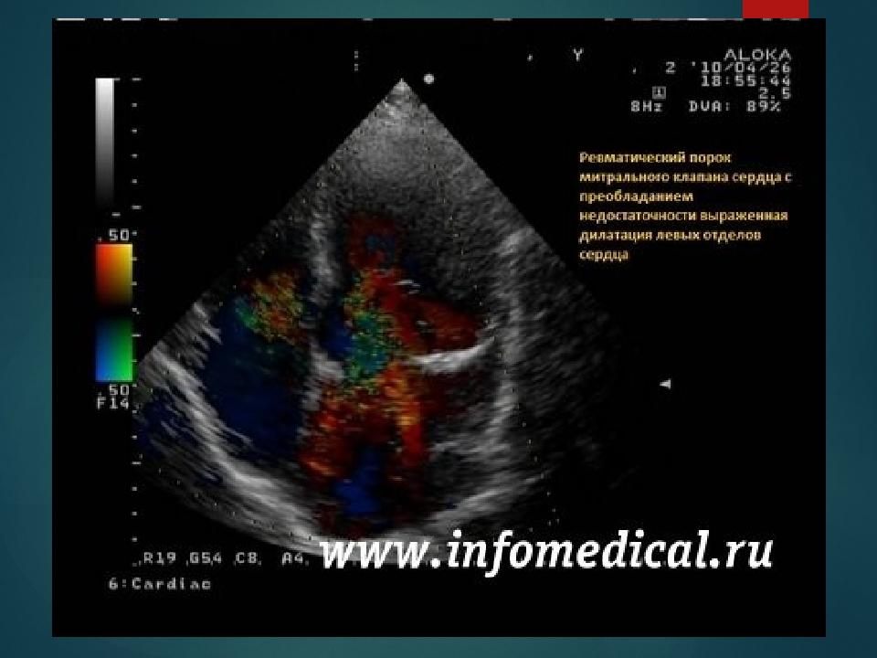 Сестринский уход при пороках сердца презентация