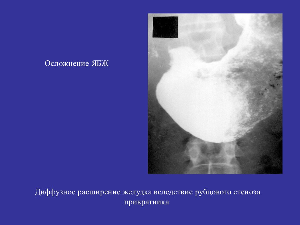 Расширение желудка. Декомпенсированный стеноз привратника. Субкомпенсированный стеноз привратника. Декомпенсированный стеноз желудка рентген. Стеноз привратника желудка рентген.