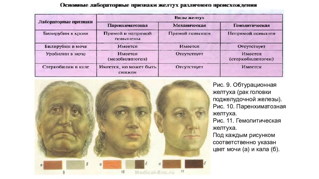 Желтуха виды. Паренхиматозная желтуха цвет кожи. Гемолитическая желтуха цвет кожи. Цвет кожных покровов при подпеченочной желтухе. Гемолитическая и паренхиматозная желтуха.