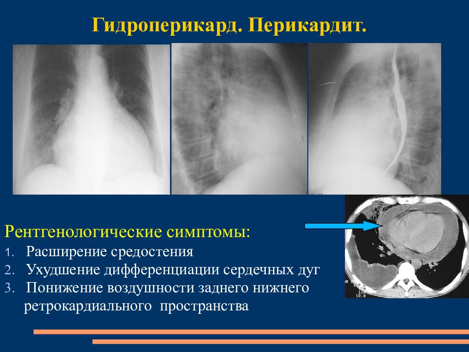 Гидроперикард. Гидроперикард рентген признаки. Выпотной перикардит рентген. Перикардит гидроперикардит. Рентгенология перикардит.
