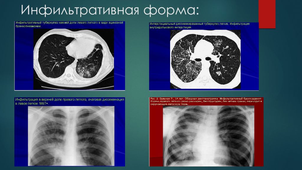 Очаговый туберкулез презентация