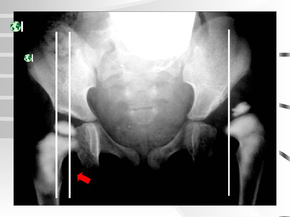 Патология тазобедренного сустава. Линия Омбредана Перкинса. Линия Омбредана в рентгене. Линия Перкинса тазобедренный сустав.