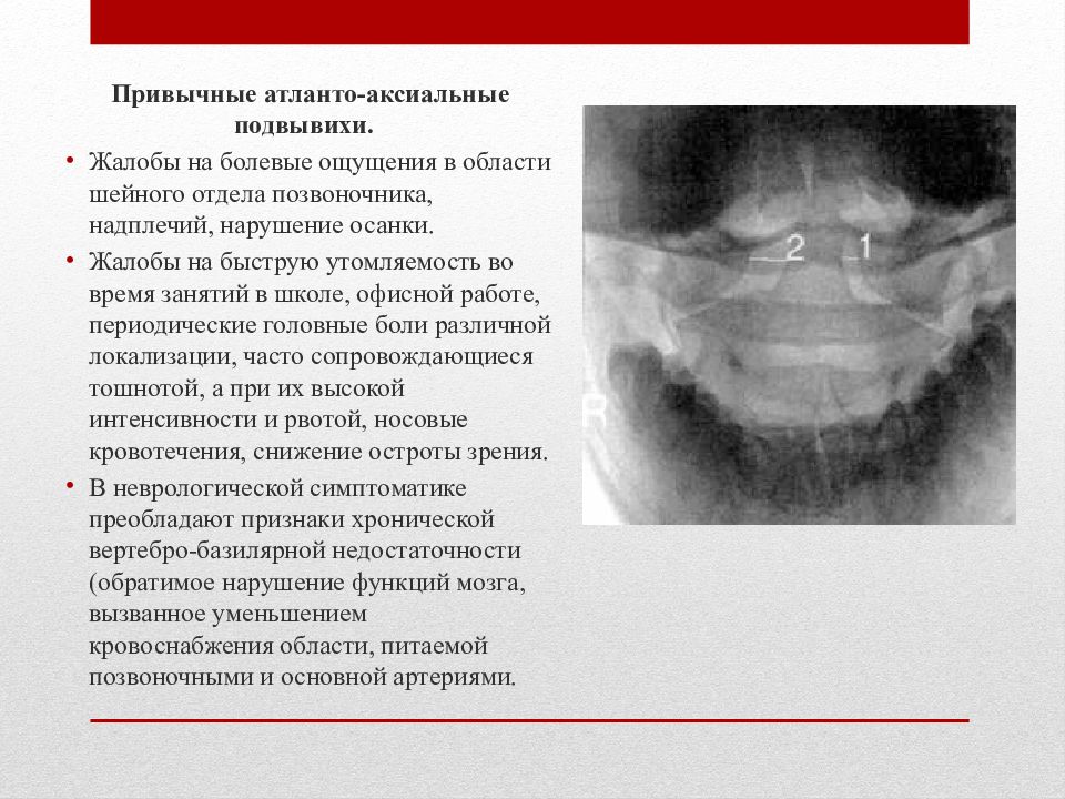 Ротационный подвывих. Ротационный подвывих с1 описание. Ротационный подвывих рентген. Атлантоакиальный подвывих.