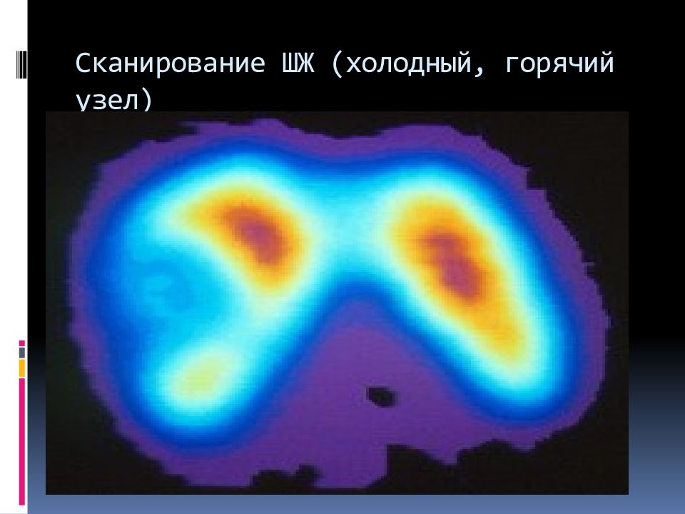 Горячий узел щитовидной железы. Холодный и горячий узел щитовидной железы. Сканограмма щитовидной железы горячий узел. Холодный теплый горячий узел щитовидной железы.