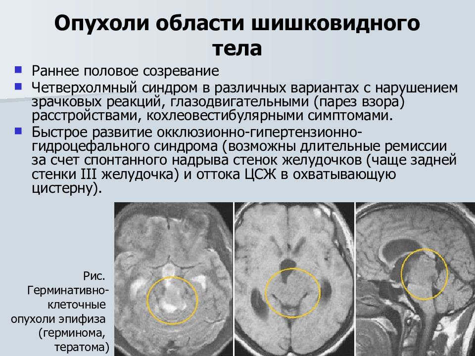 Рак головного мозга презентация