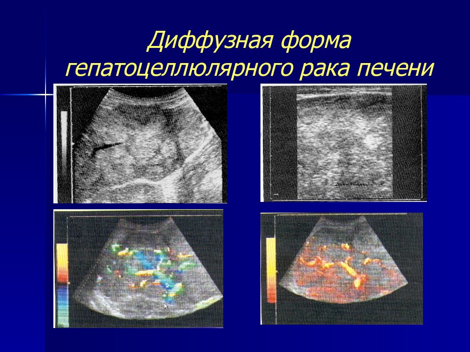 Гцк печени. Гепатоцеллюлярная карцинома печени на УЗИ. Диффузное поражение печени. Диффузные изменения печени на УЗИ. Очаговые поражения печени.