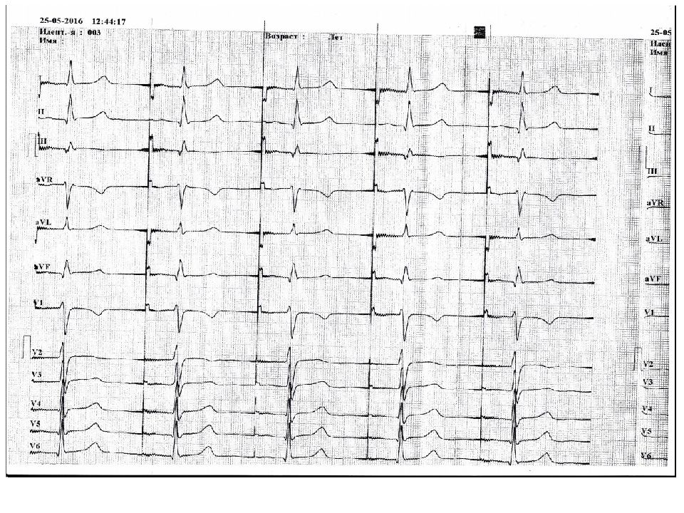 Экг презентация. ЭКГ-1800р. Аллогенный очаг на ЭКГ. Маколкин ЭКГ.