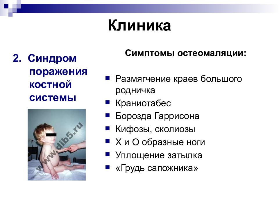 Симптомами являются. Синдром остеомаляции рахит. Периоды рахита у детей клиника.