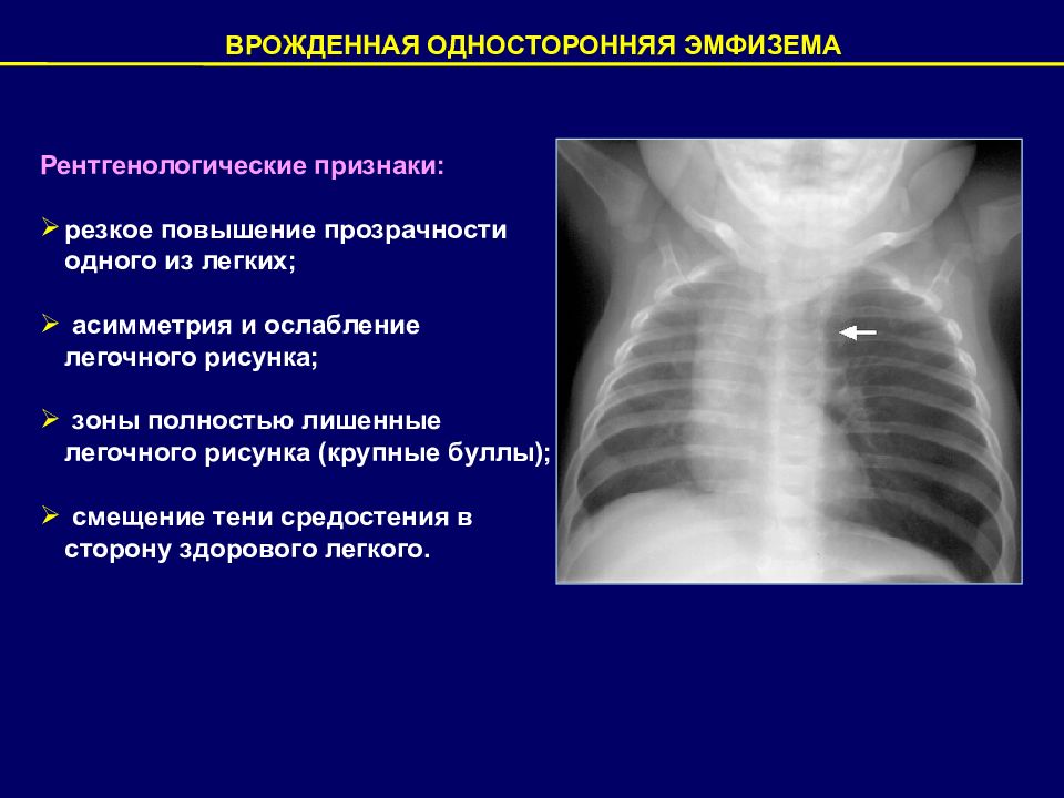 Эмфизема легких симптомы