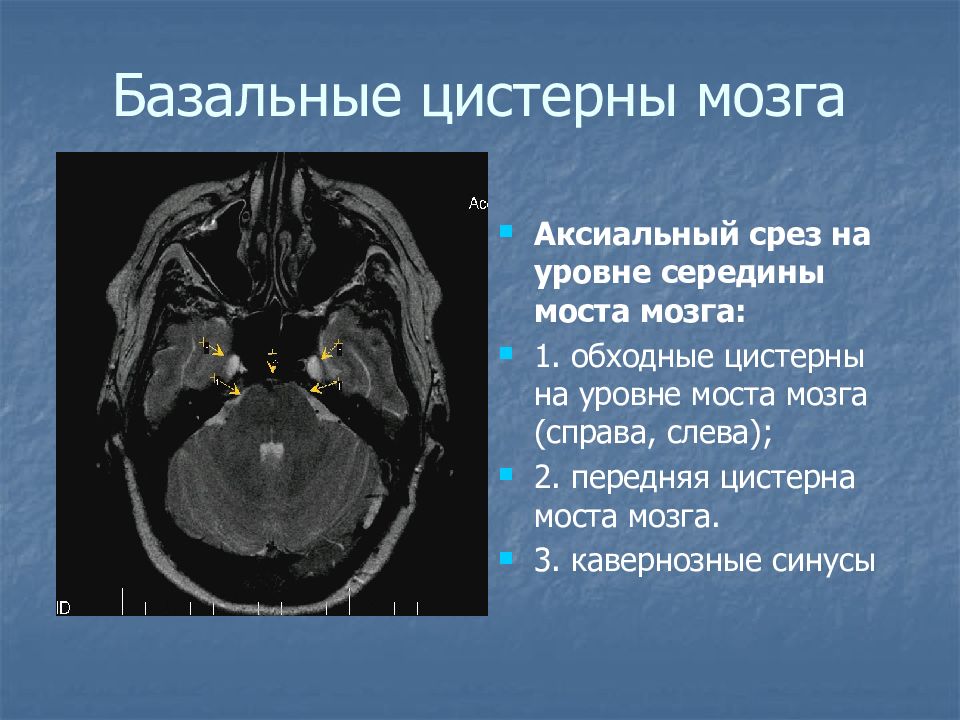 Цистерна мозга норма