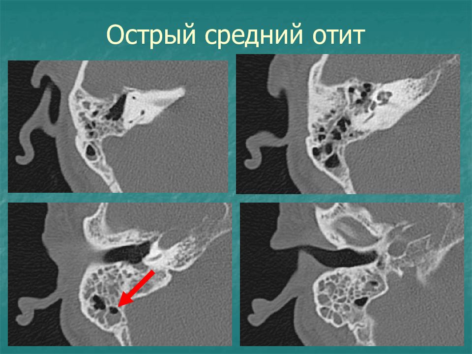 Кт костей. Хронический Гнойный средний отит кт. Острый средний отит кт. Кт височной кости при отите. Кт височной кости среднего и внутреннего уха.