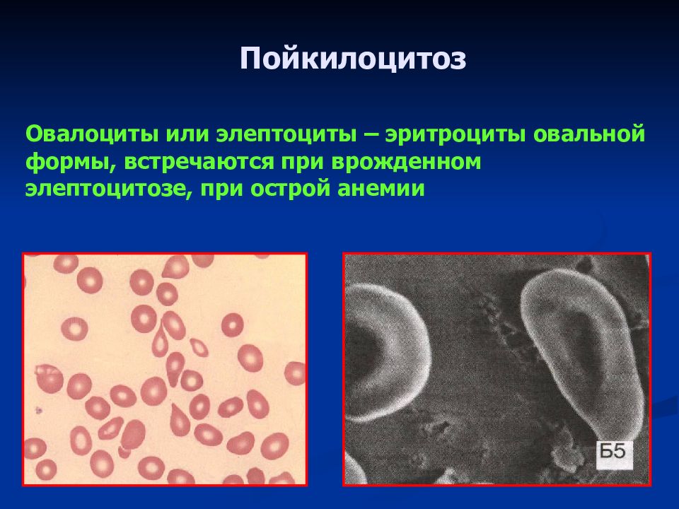 Эллиптоцитоз. Пойкилоцитоз эритроцитов. Анизоцитоз и пойкилоцитоз. Пойкилоцитоз формы эритроцитов. Пойкилоцитоз формы.