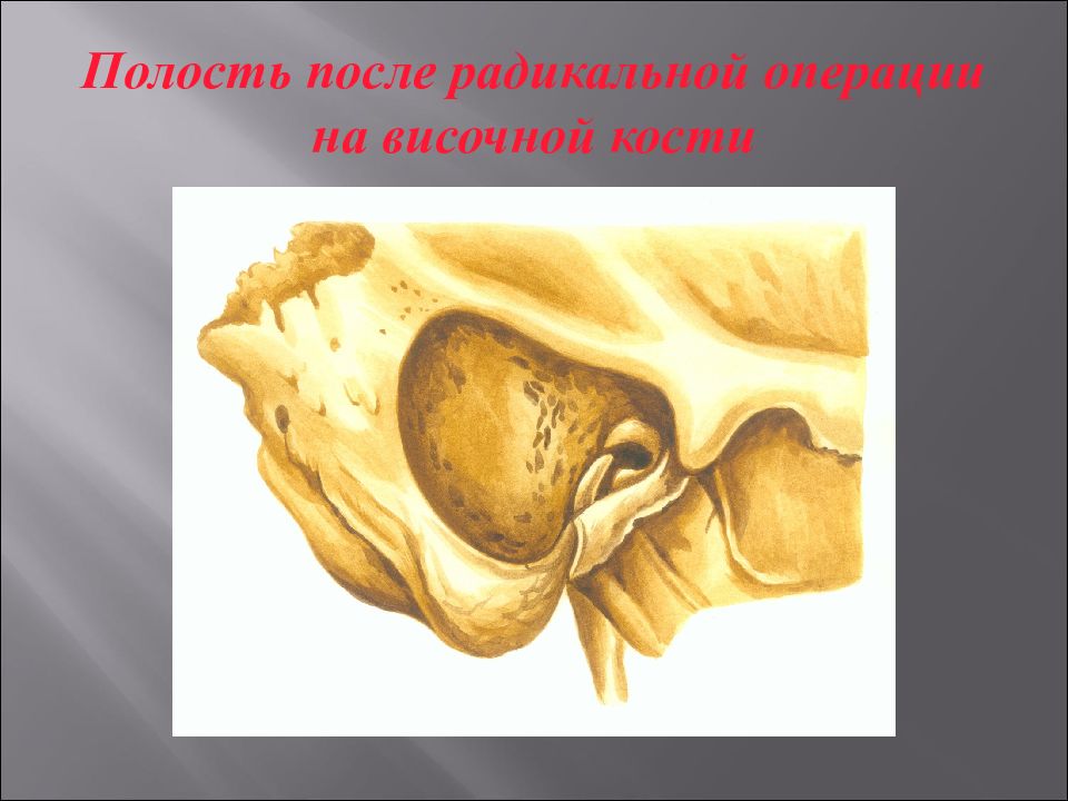 Полость после операции. Операция хронический Гнойный средний отит. Полость после Радикальной операции. Радикальная операция среднего уха. Радикальная операция на среднем ухе.