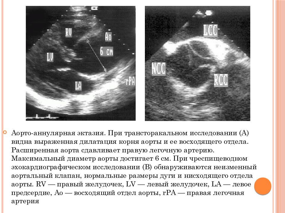 Дилатация правых отделов. Расширение коронарного синуса на УЗИ. Аневризма коронарного синуса ЭХОКГ. Аневризма коронарного синуса УЗИ. Аневризма восходящего отдела аорты ЭХОКГ.