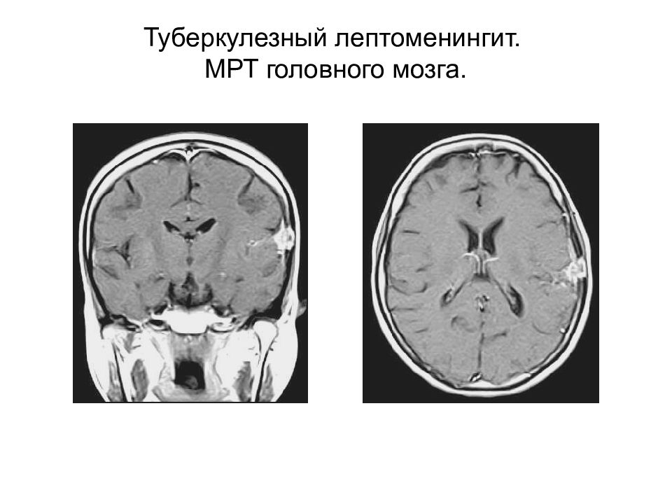 Генез мозга. Лептоменингит головного мозга мрт. Туберкулезный лептоменингит. Туберкулезный лептоменингит мрт.