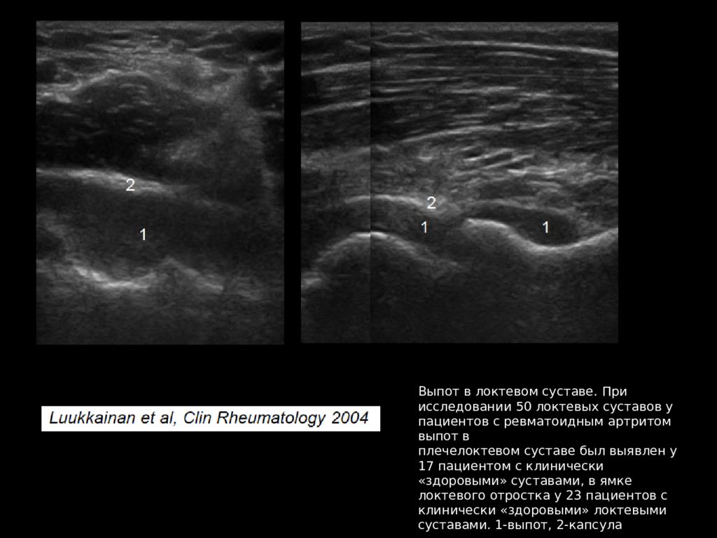 Протокол узи локтевого сустава образец