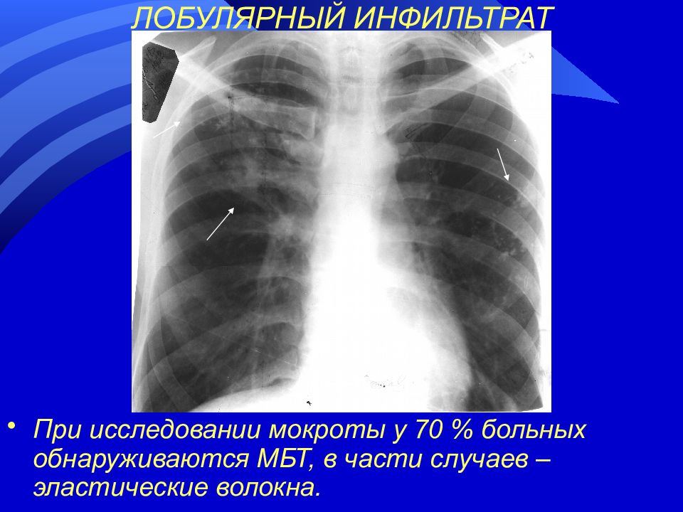 70 легких. Бронхолобулярный инфильтрат рентген. Инфильтративный туберкулез рентген лобулярный инфильтрат. Инфильтративный туберкулез Лобит рентген.